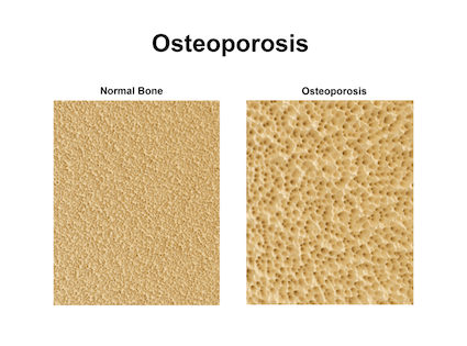 Osteoporotic Bones